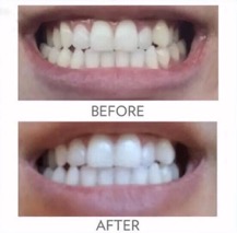 whitening_toothpaste_smile